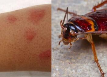 Το τσίμπημα κατσαρίδας μπορεί να αποβεί μοιραίο: Η φωτογραφία που το επιβεβαιώνει και ο τρόπος για να το αντιμετωπίσετε