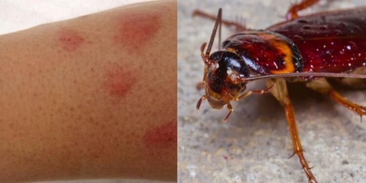 Το τσίμπημα κατσαρίδας μπορεί να αποβεί μοιραίο: Η φωτογραφία που το επιβεβαιώνει και ο τρόπος για να το αντιμετωπίσετε