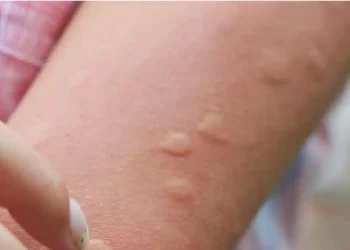 Η γιαγιά μου έμαθε αυτό το κόλπο για να απαλλαγώ από τα τσιμπήματα κουνουπιών μέσα σε δύο 2 λεπτά με 0 προσπάθεια. Να πως γίνεται