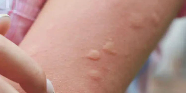 Η γιαγιά μου έμαθε αυτό το κόλπο για να απαλλαγώ από τα τσιμπήματα κουνουπιών μέσα σε δύο 2 λεπτά με 0 προσπάθεια. Να πως γίνεται