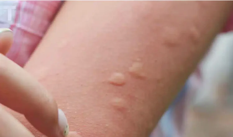 Η γιαγιά μου έμαθε αυτό το κόλπο για να απαλλαγώ από τα τσιμπήματα κουνουπιών μέσα σε δύο 2 λεπτά με 0 προσπάθεια. Να πως γίνεται