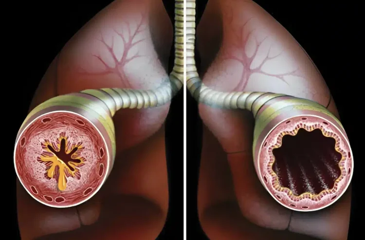 1 φλιτζάνι για να καθαρίσετε τους πνεύμονές σας από φλέγματα και τοξίνες