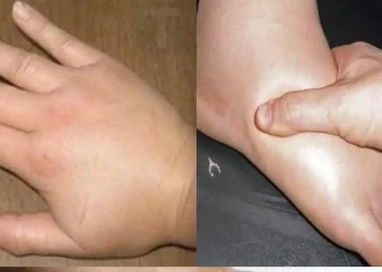 Απαλλαγείτε γρήγορα από τα πρησμένα χέρια και πόδια: Σπιτικές θεραπείες για την κατακράτηση υγρών