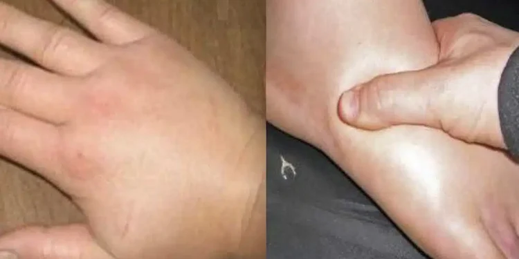 Απαλλαγείτε γρήγορα από τα πρησμένα χέρια και πόδια: Σπιτικές θεραπείες για την κατακράτηση υγρών