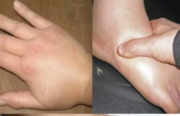 Απαλλαγείτε γρήγορα από τα πρησμένα χέρια και πόδια: Σπιτικές θεραπείες για την κατακράτηση υγρών