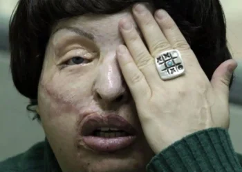 Μου έριξαν βιτριόλι επειδή είχα σχέση με παντρεμένο. Το έκανε η γυναίκα του με την κουμπάρα της – Η αληθινή ιστορία της κυρίας Άννας