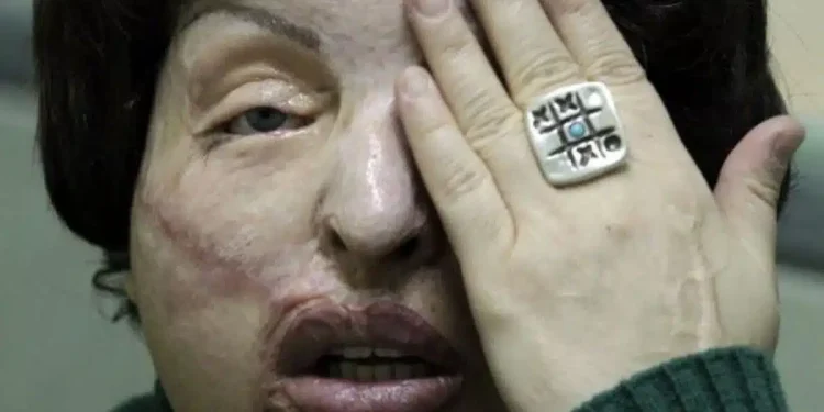 Μου έριξαν βιτριόλι επειδή είχα σχέση με παντρεμένο. Το έκανε η γυναίκα του με την κουμπάρα της – Η αληθινή ιστορία της κυρίας Άννας