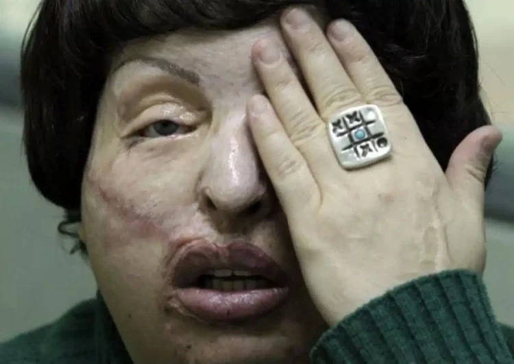 Μου έριξαν βιτριόλι επειδή είχα σχέση με παντρεμένο. Το έκανε η γυναίκα του με την κουμπάρα της – Η αληθινή ιστορία της κυρίας Άννας