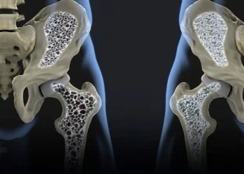 Οι κρυφοί ένοχοι πίσω από την οστεοπόρωση: 3 δημοφιλή ποτά που πρέπει να προσέξετε