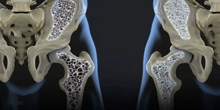 Οι κρυφοί ένοχοι πίσω από την οστεοπόρωση: 3 δημοφιλή ποτά που πρέπει να προσέξετε