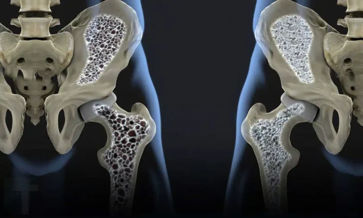 Οι κρυφοί ένοχοι πίσω από την οστεοπόρωση: 3 δημοφιλή ποτά που πρέπει να προσέξετε