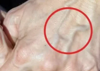 Πότε να ανησυχείτε για τις φλέβες που εμφανίζονται ξαφνικά