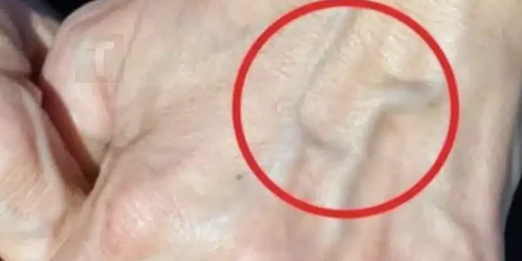 Πότε να ανησυχείτε για τις φλέβες που εμφανίζονται ξαφνικά