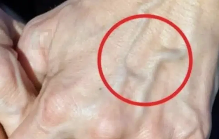 Πότε να ανησυχείτε για τις φλέβες που εμφανίζονται ξαφνικά