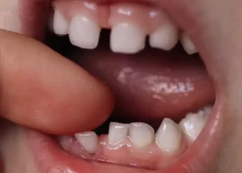 Να γιατί οι γονείς πρέπει να κρατούν τα νεογιλά δόντια του παιδιού τους. Μπορεί να σώσουν μια ζωή