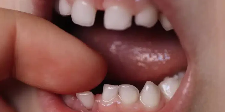 Να γιατί οι γονείς πρέπει να κρατούν τα νεογιλά δόντια του παιδιού τους. Μπορεί να σώσουν μια ζωή