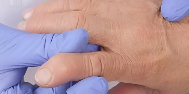 Τρόφιμα που πρέπει να αποφύγετε όταν έχετε ρευματοειδή αρθρίτιδα