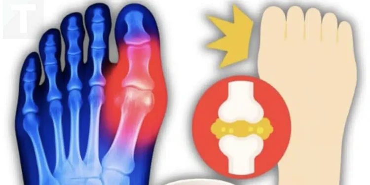 Το #1 ρόφημα για να αντιστρέψετε το υψηλό ουρικό οξύ και την ουρική αρθρίτιδα