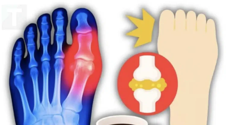 Το #1 ρόφημα για να αντιστρέψετε το υψηλό ουρικό οξύ και την ουρική αρθρίτιδα