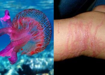 Τι να κάνετε αν σας τσιμπήσει μωβ τσούχτρα – Οι απαραίτητες πρώτες βοήθειες για να απαλύνετε τον πόνο