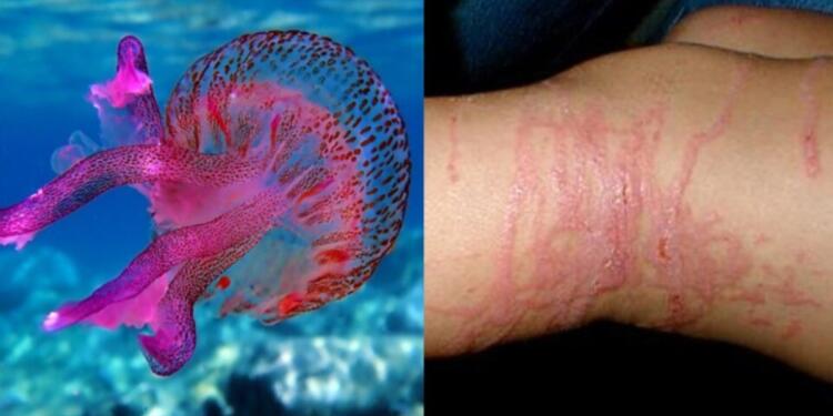 Τι να κάνετε αν σας τσιμπήσει μωβ τσούχτρα – Οι απαραίτητες πρώτες βοήθειες για να απαλύνετε τον πόνο