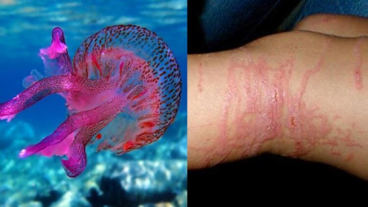 Τι να κάνετε αν σας τσιμπήσει μωβ τσούχτρα – Οι απαραίτητες πρώτες βοήθειες για να απαλύνετε τον πόνο