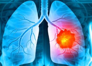 Τα καλά νέα της ημέρας: Νέα θεραπεία για τον καρκίνο του πνεύμονα με ελληνική σφραγίδα
