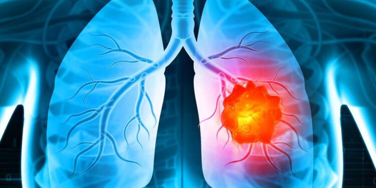 Τα καλά νέα της ημέρας: Νέα θεραπεία για τον καρκίνο του πνεύμονα με ελληνική σφραγίδα