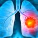 Τα καλά νέα της ημέρας: Νέα θεραπεία για τον καρκίνο του πνεύμονα με ελληνική σφραγίδα