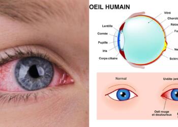 Πόνος στα μάτια και θολή όραση: Η φλεγμονή που μπορεί να προκαλέσει τύφλωση