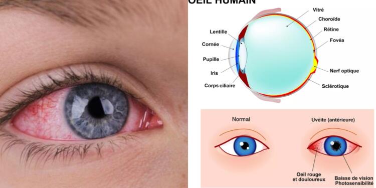 Πόνος στα μάτια και θολή όραση: Η φλεγμονή που μπορεί να προκαλέσει τύφλωση