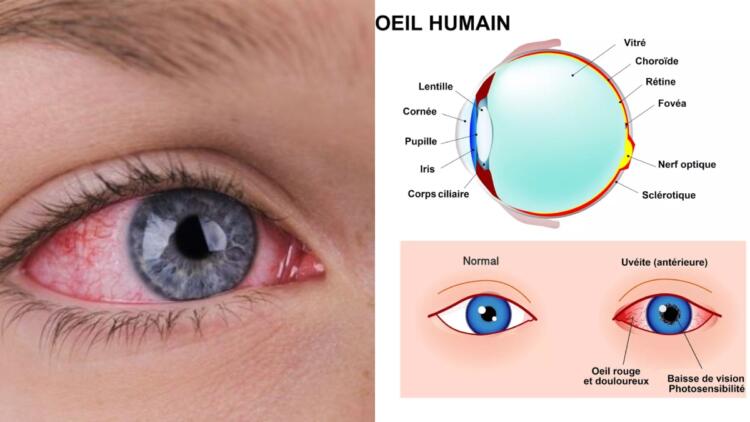 Πόνος στα μάτια και θολή όραση: Η φλεγμονή που μπορεί να προκαλέσει τύφλωση