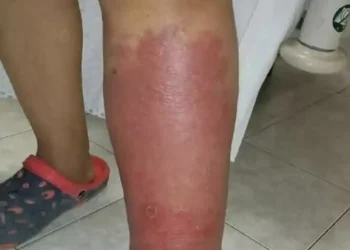 Σημάδια στα πόδια σας – Όλα όσα πρέπει να γνωρίζετε για το πρήξιμο