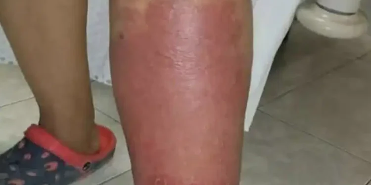 Σημάδια στα πόδια σας – Όλα όσα πρέπει να γνωρίζετε για το πρήξιμο