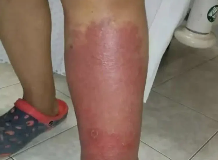 Σημάδια στα πόδια σας – Όλα όσα πρέπει να γνωρίζετε για το πρήξιμο