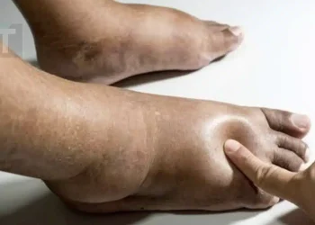 Τροφές που βοηθούν στη μείωση του πρηξίματος σε χέρια ή πόδια