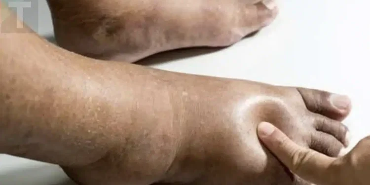 Τροφές που βοηθούν στη μείωση του πρηξίματος σε χέρια ή πόδια