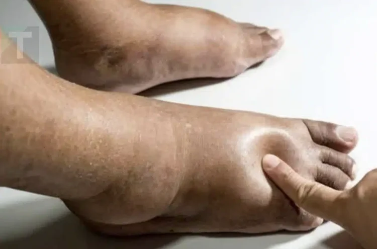 Τροφές που βοηθούν στη μείωση του πρηξίματος σε χέρια ή πόδια