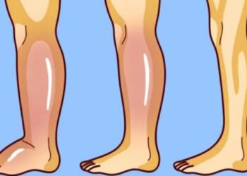 Πρήξιμο στα πόδια από τη ζέστη: Γιατί συμβαίνει και τι να κάνεις