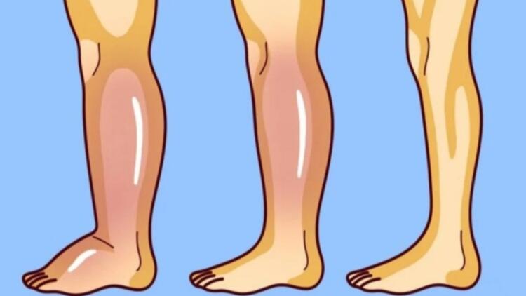 Πρήξιμο στα πόδια από τη ζέστη: Γιατί συμβαίνει και τι να κάνεις