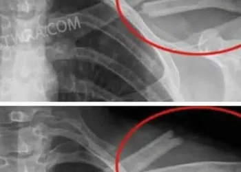 Auτό το ποτό θα καταστρέψει τα κόκαλα σας από μέσα αλλά όλοι το πίνουν