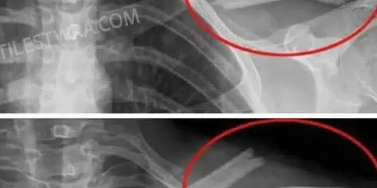 Auτό το ποτό θα καταστρέψει τα κόκαλα σας από μέσα αλλά όλοι το πίνουν