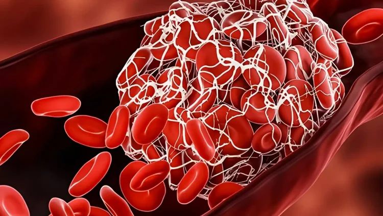 8 θρεπτικά συστατικά που χρειάζεστε για να διαλύσετε τους θρόμβους αίματος τώρα