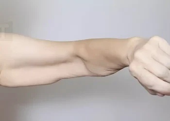 Σαρκοπενία: Αιτίες απώλειας μυϊκής μάζας και λύσεις