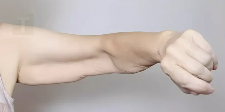 Σαρκοπενία: Αιτίες απώλειας μυϊκής μάζας και λύσεις