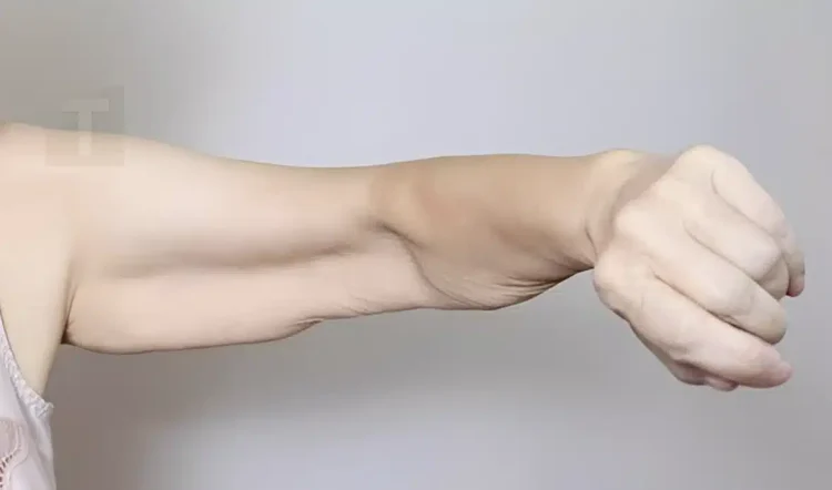 Σαρκοπενία: Αιτίες απώλειας μυϊκής μάζας και λύσεις