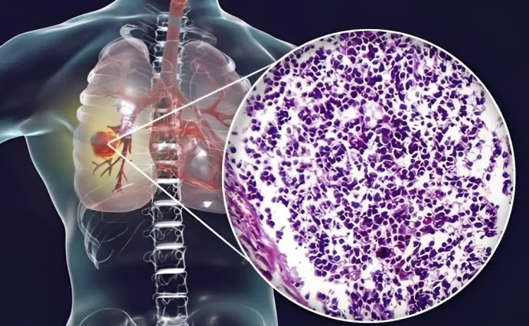 Ο αόρατος κίνδυνος – Τι κοινό υλικό κουζίνας συνδέεται με καρκίνο πνεύμονα – Προσοχή στο σπίτι σας