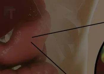 Πώς να απαλλαγείτε από το βακτήριο που ευθύνεται για την καούρα και το φούσκωμα