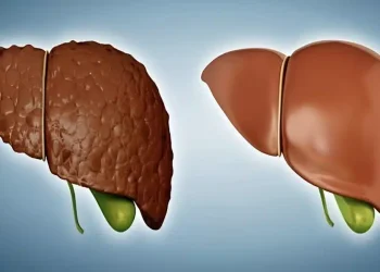 Λιπώδες ήπαρ: Το διατροφικό πλάνο που «καίει» το λίπος στο συκώτι και βοηθά σε ταχεία απώλεια βάρους