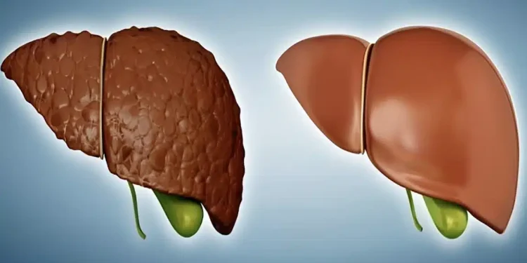 Λιπώδες ήπαρ: Το διατροφικό πλάνο που «καίει» το λίπος στο συκώτι και βοηθά σε ταχεία απώλεια βάρους